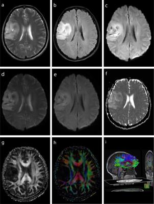 Advanced Diagnosis of Glioma by Using Emerging Magnetic Resonance Sequences